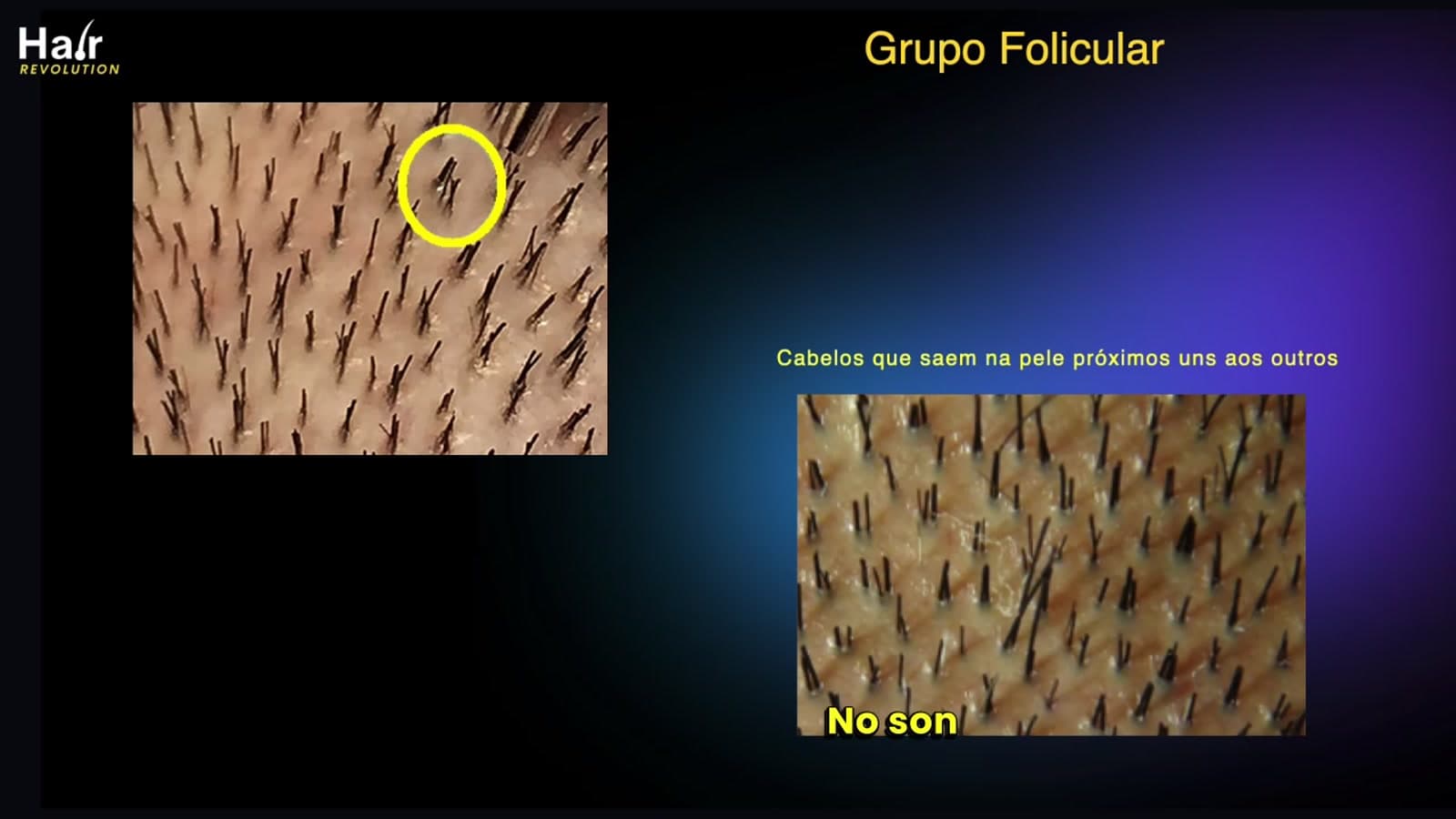 Diapositiva de la clase: grupos foliculares en la piel